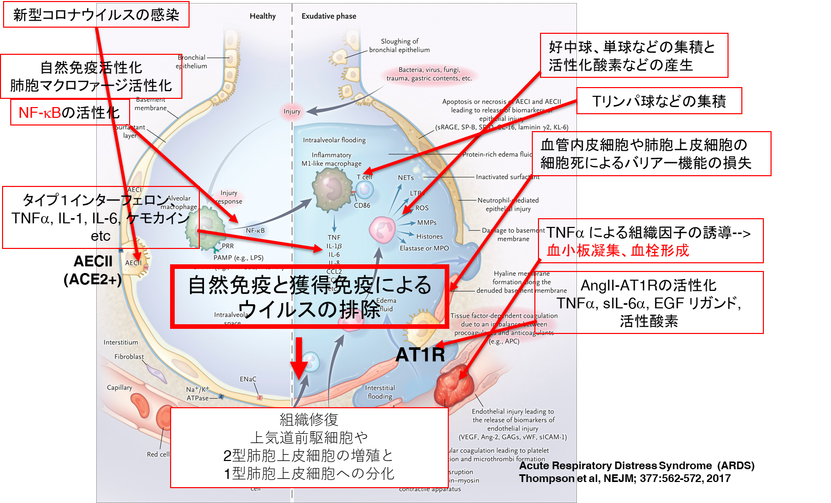 Covid 19はサイトカインストーム症候群である Covid 19有識者会議