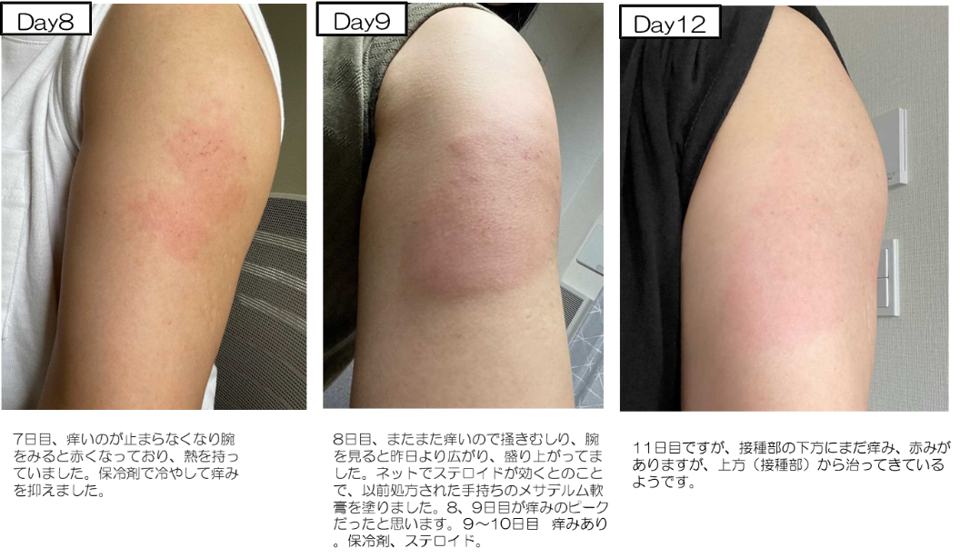 新型コロナウイルスワクチンの副反応 Covid 19有識者会議